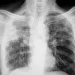 TB Resurges in UK: Victorian Killer Disease Strikes Again