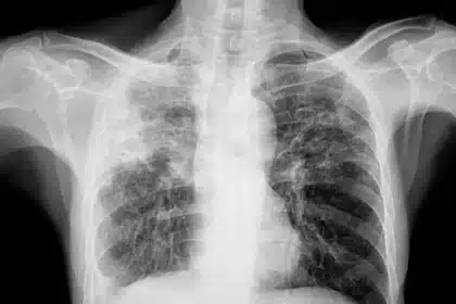 TB Resurges in UK: Victorian Killer Disease Strikes Again