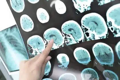 Hip Exoskeleton Cuts Walking Energy 20% for Stroke Survivors