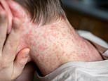 Victoria Alerts Thousands to Measles Risks from Recent Travel-Linked Cases
