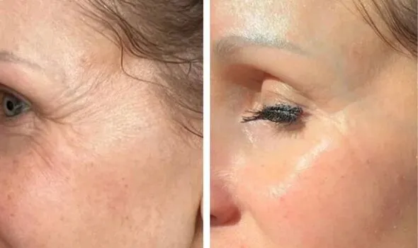 Keskine LED Mask £219 Off: Youthful Skin Without Makeup